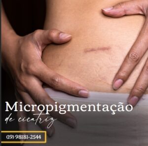 Micropgmentação de cicatriz